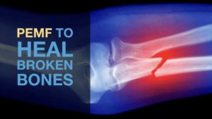 PEMF To Heal Broken Bones​